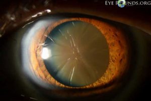 eye with cataract